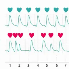 Dwa wykresy EKG, jeden z zielonym znacznikiem i 60 BPM, drugi z czerwonym i 60 BPM. Rytm serca jest regularny, ale w drugim przypadku tetno 100 wydaje się być nieregularne.