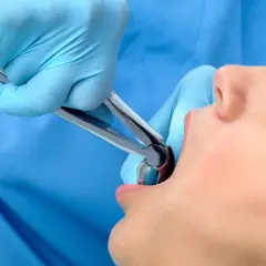 Dentysta w niebieskich rękawiczkach używa kleszczy do ekstrakcji zęba, pozostawiając dziwny posmak po wyrwaniu zęba.