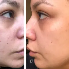 Split image showing a woman's cheek before and after treatment, with reduced redness and blemishes.