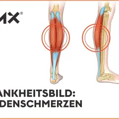 Anatomische Darstellung der Beinmuskulatur mit Hervorhebung der Wadenmuskeln. Rote Kreise markieren Bereiche, die auf **Schmerzen in der Wade** hinweisen könnten.