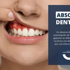 Primer plano de una boca mostrando encías rojas e inflamadas, indicativo de un absceso en la encía. Texto informativo sobre abscesos dentales.