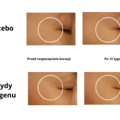 Porównanie skóry przed i po 12 tygodniach. Grupa placebo bez zmian, grupa z peptydami kolagenu wykazuje redukcję zmarszczek, co może być oznaką, że nadmiar kolagenu objawy nie są widoczne.