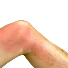 Silne czerwone plamy na nodze, widoczne zaczerwienienie skóry po opalaniu.