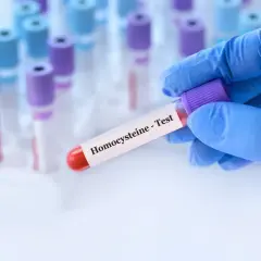 Rękawiczka trzyma probówkę z krwią do badania homocysteiny. Co to jest homocysteina? To aminokwas, którego poziom we krwi jest ważny dla zdrowia.