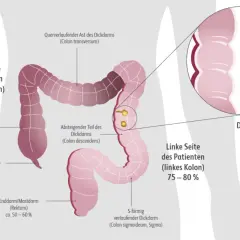 Illustration des Dickdarms mit Markierung des Rektums (ca. 50-60%). Darmpolypen können frühe rektumkarzinom symptome sein.
