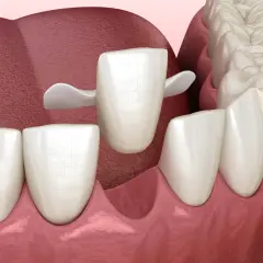 Una corona dentale bianca si posiziona su un dente preparato, pronta a proteggere un dente che si stacca.