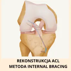 Rekonstrukcja ACL prywatnie czy na NFZ – co wybrać, by uniknąć błędów i kosztów?