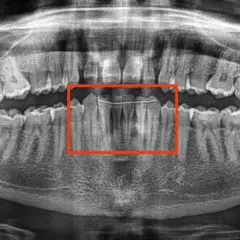 Radiografia panoramica dei denti con un filo metallico che stabilizza i denti anteriori. Un dente che si muove si può salvare con cure adeguate.