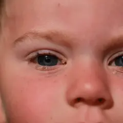 Ojos de niño con secreción, sugiriendo la necesidad de gotas para conjuntivitis en niños.