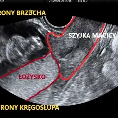 Jak oczyścić łożysko w ciąży i uniknąć poważnych problemów zdrowotnych