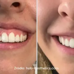 Uśmiech przed i po zabiegu botoksu na gummy smile. Widoczna różnica w odsłanianiu dziąseł.