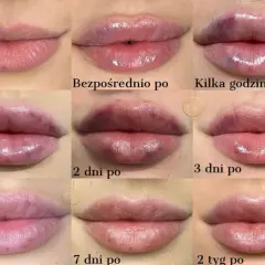 Kwas hialuronowy w ustach: Ile się utrzymuje i jak przedłużyć efekt?
