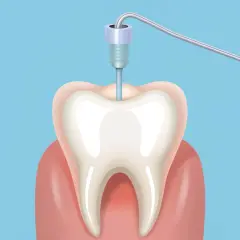 Ilustracja przedstawia narzędzie dentystyczne w zębie, symbolizujące potencjalne objawy stanu zapalnego po leczeniu kanałowym.