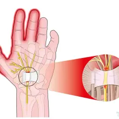 Illustrazione anatomica che mostra la compressione di un nervo nel polso, causa di dolore alla mano.