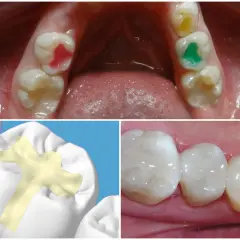 Sigillatura molari bambini: pro e contro. Denti con sigillante colorato e modello 3D di applicazione.