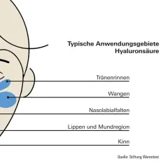 Schema zeigt typische Anwendungsgebiete für Hyaluron in der Haut: Tränenrinnen, Wangen, Nasolabialfalten, Lippenregion und Kinn.
