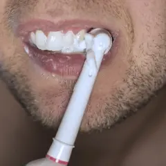 Bocca con denti bianchi e spazzolino elettrico. Nonostante la cura, la carie è una preoccupazione.