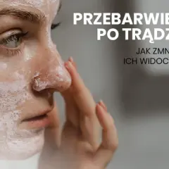 Jak pozbyć się blizn po pryszczach? Domowe i profesjonalne metody