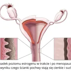 Ilustracja pokazuje zmiany w pochwie podczas menopauzy, prowadzące do suchości pochwy.