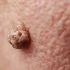 Gros plan d'un acrochordon douloureux sur la peau, texture rugueuse et irrégulière.