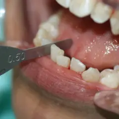 Herramienta dental mide 0.50mm para limar dientes, parte del proceso de tratamiento con Invisalign.