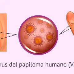Síntomas del papiloma humano en mujeres: lo que debes saber para actuar