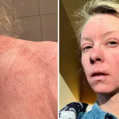 Bilden visar en person med svår hudirritation och fjällning på halsen och ansiktet, möjligen som en reaktion på thiamidol biverkningar.