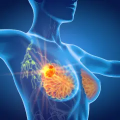 Anatomical rendering showing a tumor in the breast and enlarged lymph nodes in the armpit, indicating potential spread and causing ból pod pachą.