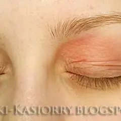 Alergia na oprawki okularowe: objawy, przyczyny i jak sobie radzić