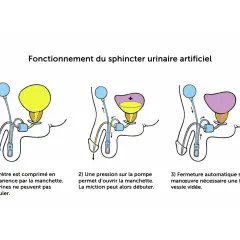 Schéma du fonctionnement d'un sphincter urinaire artificiel, une solution pour les fuites urinaires après prostatectomie totale.
