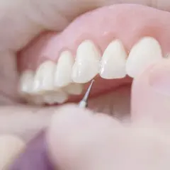 Dettaglio di una dentiera che viene posizionata, un passo importante per abituarsi alla dentiera e ritrovare un sorriso smagliante.
