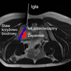 Leczenie zapalenia stawu krzyżowo-biodrowego: od leków po terapie