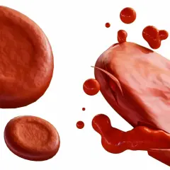 Czerwone krwinki, jedna z nich pęka, uwalniając zawartość. To obraz hemolizy, procesu rozpadu erytrocytów.