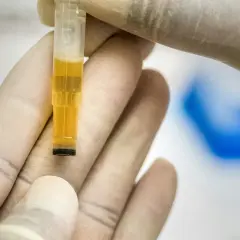 Rękawiczki laboratoryjne trzymają probówkę z żółtym płynem, wskazującym na leukocyty w moczu podwyższone.