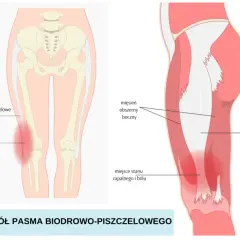 Jak długo trwa ból kolana po bieganiu i co go powoduje?