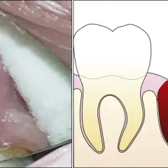 Comparación de un diente con coágulo sanguíneo y alveolitis seca, mostrando los síntomas de alveolitis seca.