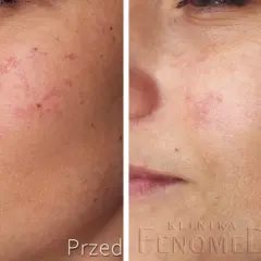Przed i po zabiegu zamykania naczynek na twarzy. Widoczna redukcja zaczerwienień i widocznych naczynek.