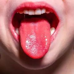 Bocca di bambino con lingua rossa e un po' bianca, possibile sintomo di streptococco.