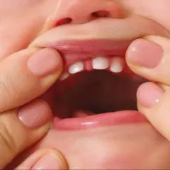 Bebé con frenillo labial inferior inflamado, mostrando sus pequeños dientes.
