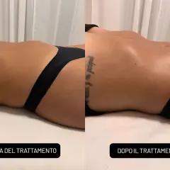 Confronto prima e dopo un massaggio rassodante: la pelle appare più tonica e liscia.