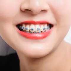 Sonrisa con brackets azules. A veces, los ataches me hacen heridas, pero la sonrisa vale la pena.