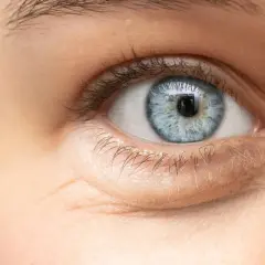 Ojo azul con ojeras hinchadas y finas arrugas bajo el párpado inferior.