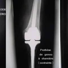 Radiographies de genoux avec prothèses. La question "peut on s'accroupir avec une prothèse du genou" est illustrée par différents types de prothèses.
