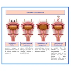 Illustration des types d'incontinence urinaire. L'incontinence d'effort survient quand on tousse ou éternue, un peu comme quand j'éternue je fais pipi.