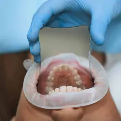 Dentista examina dientes con espejo, detectando una caries leve.