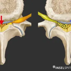 Vergleich: Spinalkanalstenose LWS mit Druck (rot) vs. Entlastung (blau). Die Darstellung zeigt, wie sich die Nervenwurzeln bei einer Spinalkanalstenose LWS verhalten.