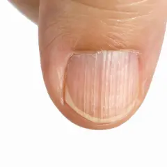 Dettaglio di un pollice con unghie rigate verticalmente, che mostrano una texture naturale e delicata.