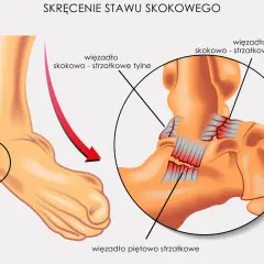 Ilustracja pokazuje skręcenie stawu skokowego, uwypuklając więzadła i mięśnie. Czerwona strzałka wskazuje kierunek urazu.