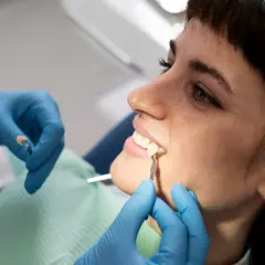 Dentysta dopasowuje kolor porcelany do lekko ukruszonego zęba. Cena zabiegu zależy od materiału.