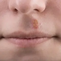 Herpes mento: lesione cutanea con crosticine giallastre e arrossate sul labbro superiore, vicino al naso.